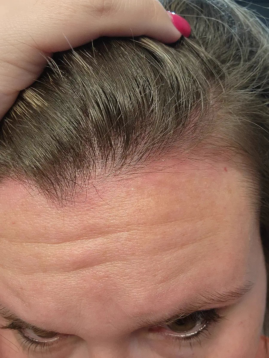 Customer lifting hair to show the front hairline and scalp