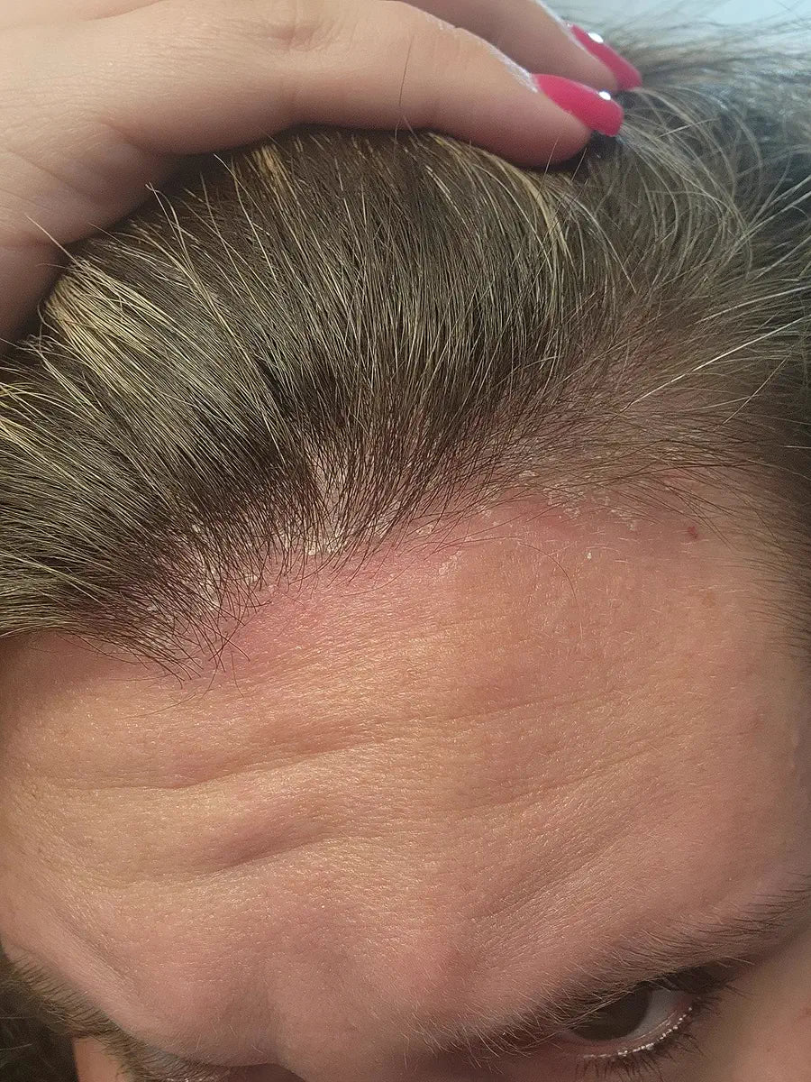 Front hairline and scalp shown in close-up